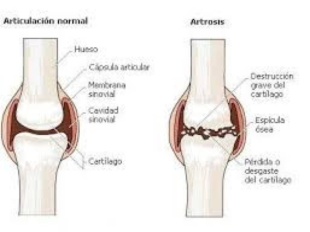 imagen 3º parte, artrosis de rodilla